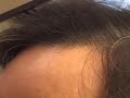 Hair transplant closeup:  asian hairline