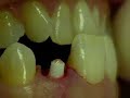 CeraRoot Zirconia Dental Implant Surgery (lateral incisor) CeraRoot Zirconia Dental Implant Surgery (lateral incisor)