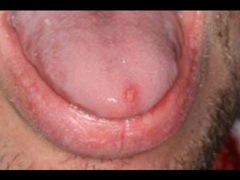The Difference Between Canker Sores and Herpes [DermTV.com Epi #103]