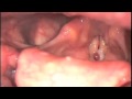 Hoarseness Caused by Red Vocal Fold Polyp Hoarseness Caused by Red Vocal Fold Polyp