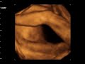 Dzaky Mom 6 Month Pregnant   4 Dimension UltraSonoGraphy 4 Ultrasonography