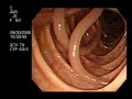 Colonoscopy Demonstrating a Moving Worm Colonoscopy Demonstrating a Moving Worm