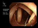 Colonoscopy Demonstrating a Moving Worm
