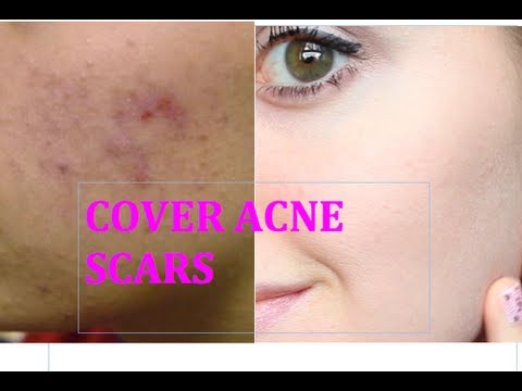 how to cover up acne scars