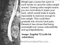 Being Overweight and Back Pain