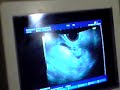 échographie des 3 mois de notre bébé