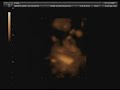 Baby 4D Ultrasound 27 Weeks