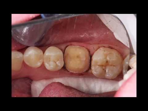 how to whiten ceramic crowns