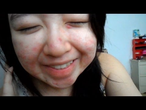 My Acne Story: 6th Week of Accutane