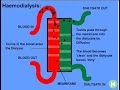 hemodialysis hemodialysis