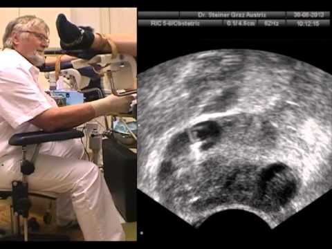 how to cure ohss