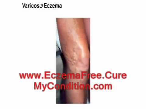how to keep eczema from spreading