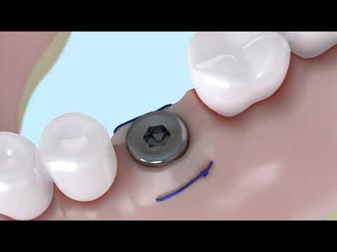 Операция №7 Удаление зуба с имплантацией без дефекта