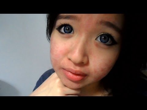 My Acne Story: 12th week of Accutane
