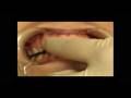 All-Wire-Retainer-in