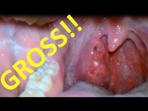 how to remove tonsil stones