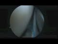 I uploaded a YouTube video -- UK Surgeon - www.shouldersurgery.org.uk - Arthroscopic Sh... http://youtu.be/HUusN-LMCiw?a