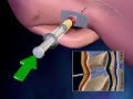 epidural-heaven.html