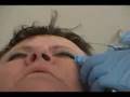 Dystonia Blepharospasm Botox B injections is very painful