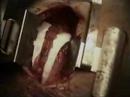 koroner bypass ameliyati, turkiye
coronary bypass surgery, turkey
http://www.gata.edu.tr/cerrahibilimler/kalpdamar/index.html