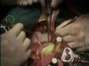 CORONARY BYPASS SURGERY CORONARY BYPASS SURGERY