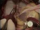 koroner bypass ameliyati, turkiye
coronary bypass surgery, turkey
http://www.gata.edu.tr/cerrahibilimler/kalpdamar/index.html