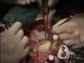 CORONARY BYPASS SURGERY
