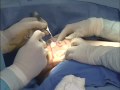 Breast Lift from start to finsih