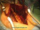 laminoplastia via posterior