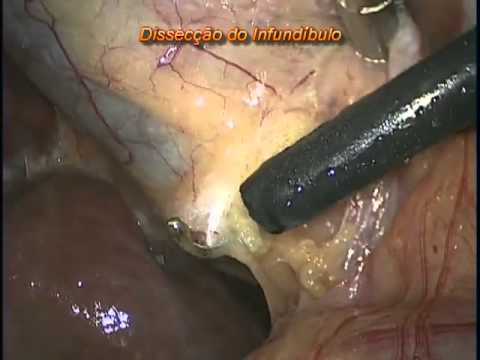 how to dissolve abdominal adhesions