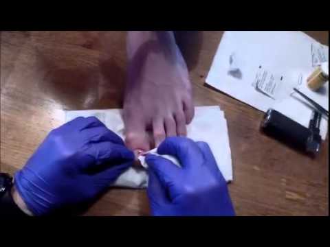how to drain subungual hematoma