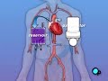 PreOp® Coronary Artery Bypass CABG) Patient Education
