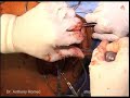 Scapulothoracic Fusion for Fascoscapulohumeral Muscular Dystrophy, Part 7 Scapulothoracic Fusion for Fascoscapulohumeral Muscular Dystrophy, Part 7
