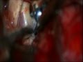 MULTIPLE INTERNAL CAROTID ARTERY aneurysms-intra operation rupture-dr suresh dugani/HUBLI/INDIA