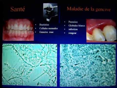 gencive - http://www.parodontite.com/ Biofilm tiré d'une gencive en santé et d'une gencive malade. Dans la santé on retrouveau microscope des bactéries anodines sous f...