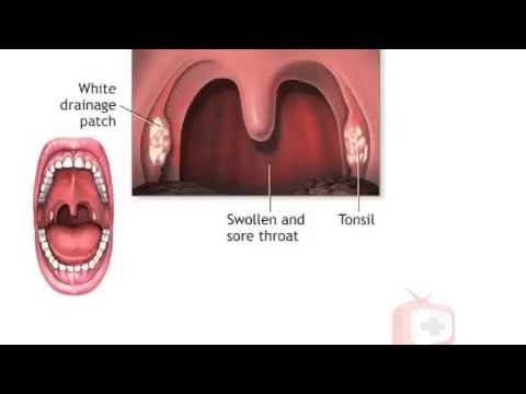 how to relieve pharyngitis