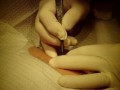Cyst Removed