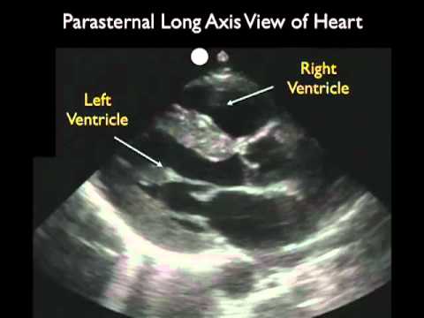 how to measure aorta on ultrasound
