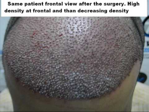 hair transplantation in India - This is 3rd generation advance hair transplantation by face value clinic Mumbai. We are technically sound, trained and exclusively focused on hair transplant...