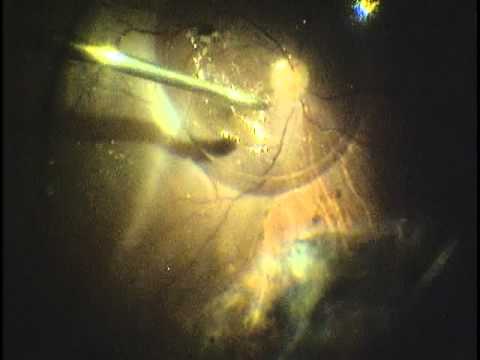 how to treat cmv retinitis