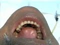 Hipnose - Remoção de Tórus Mandibular Hipnose - Remoção de Tórus Mandibular