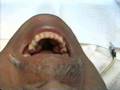 Hipnose - Remoção de Tórus Mandibular