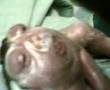 Anencephalic baby