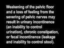  hysterectomy ovaries oophorectomy castration sex orgasm fibroids endometriosis prolapse informed consent