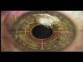Jim Stoddard's Version of my Lasik Video