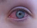 CONTACT LENSES