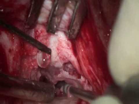 Osteoma of the External Ear Canal