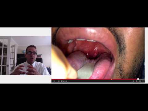 how to drain abscess in throat