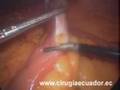 Mini Gastric Bypass in Ecuador