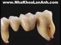 Nha khoa Lan Anh - Toan su Cercon Zirconia - chuan muc moi!